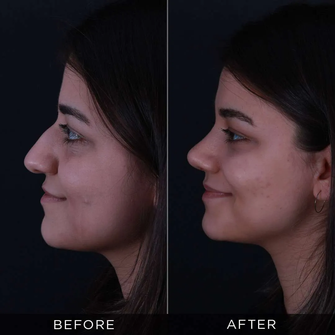 6 months after rhinoplasty at the age of 20