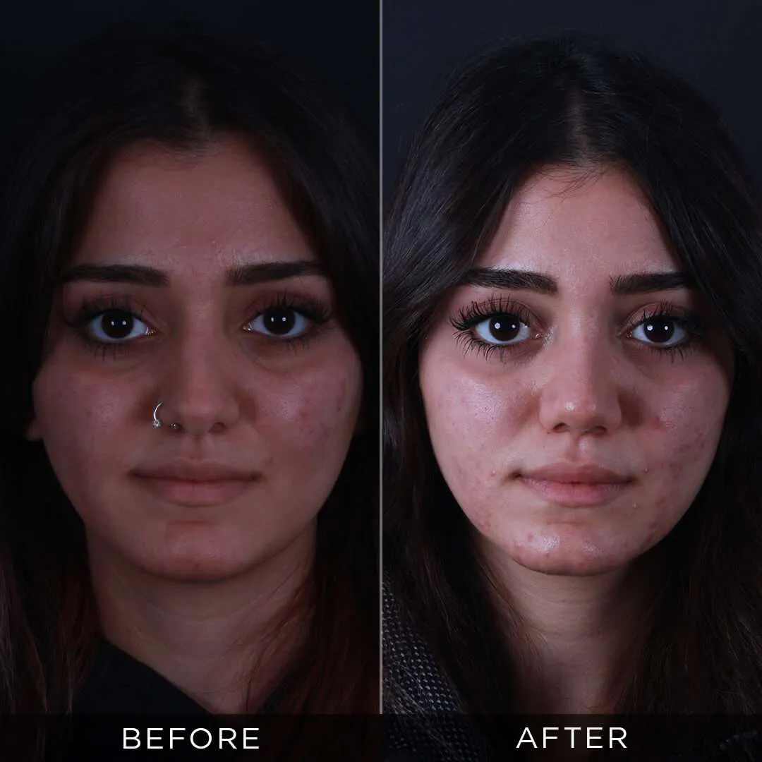 Septoplasty in Turkey 21 year old woman 1 year after rhinoplasty