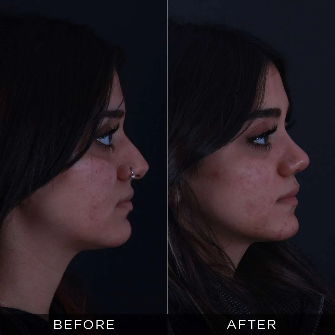 Septoplasty in Turkey rhinoplasty for women 21 years old in turkey