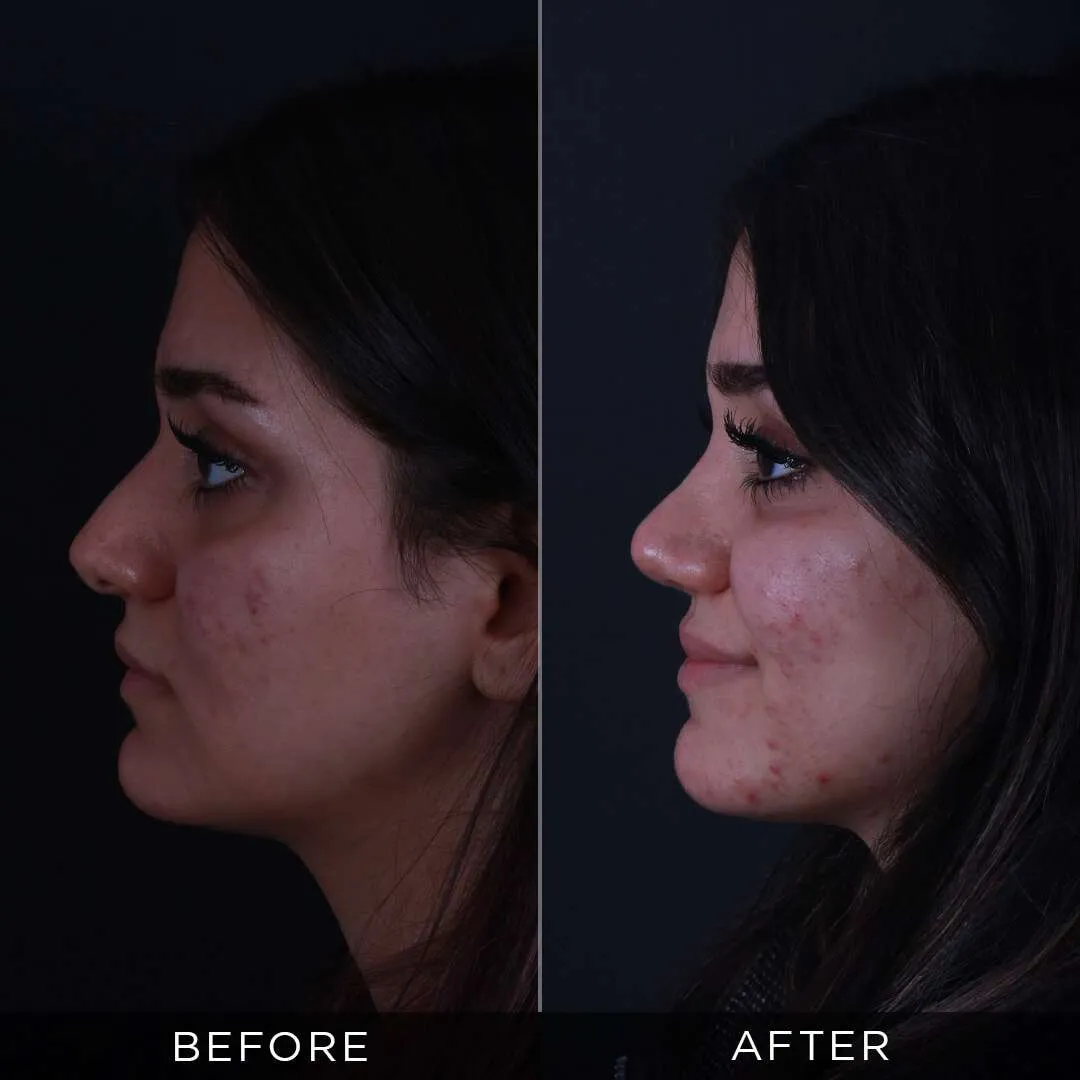 Septoplasty in Turkey 21 year old woman piezzo rhinoplasty