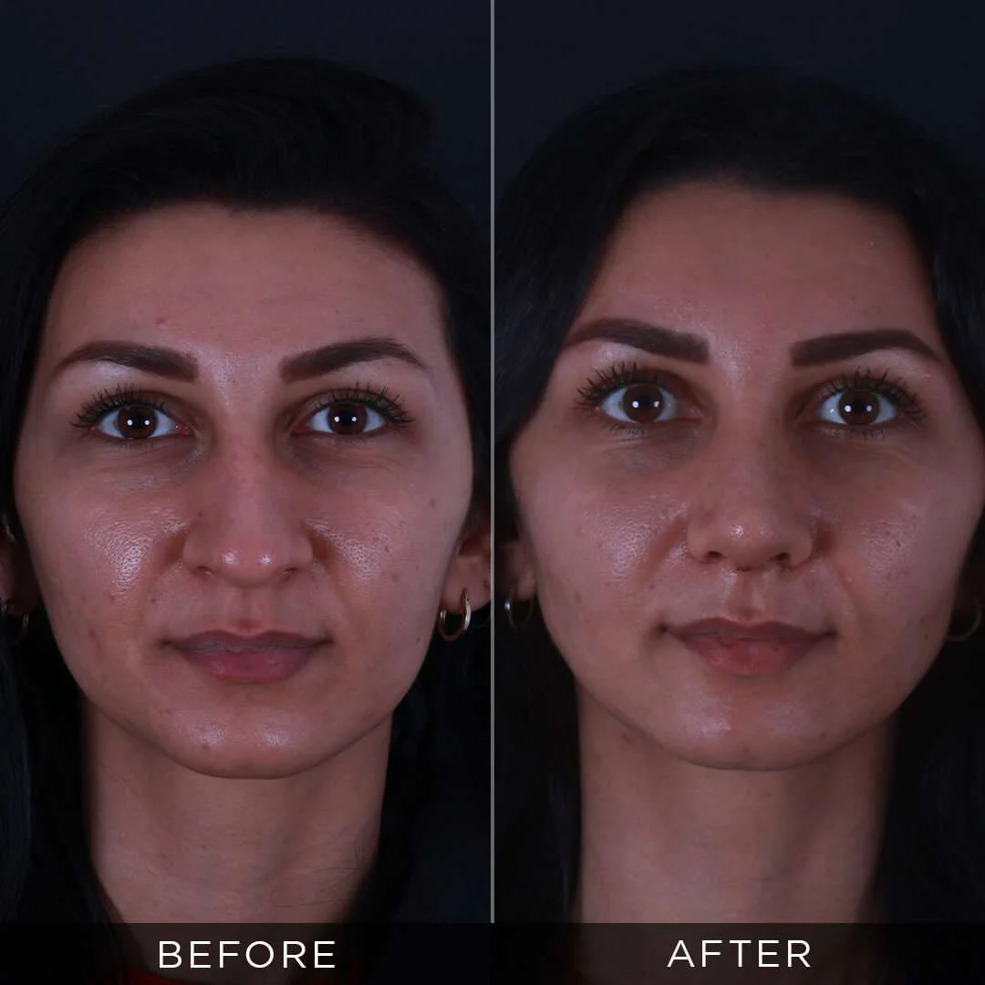 29 years old before and after rhinoplasty