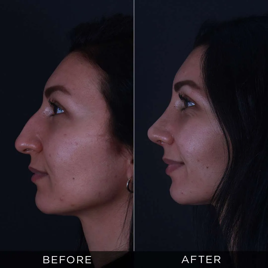 29 year old woman one month after rhinoplasty