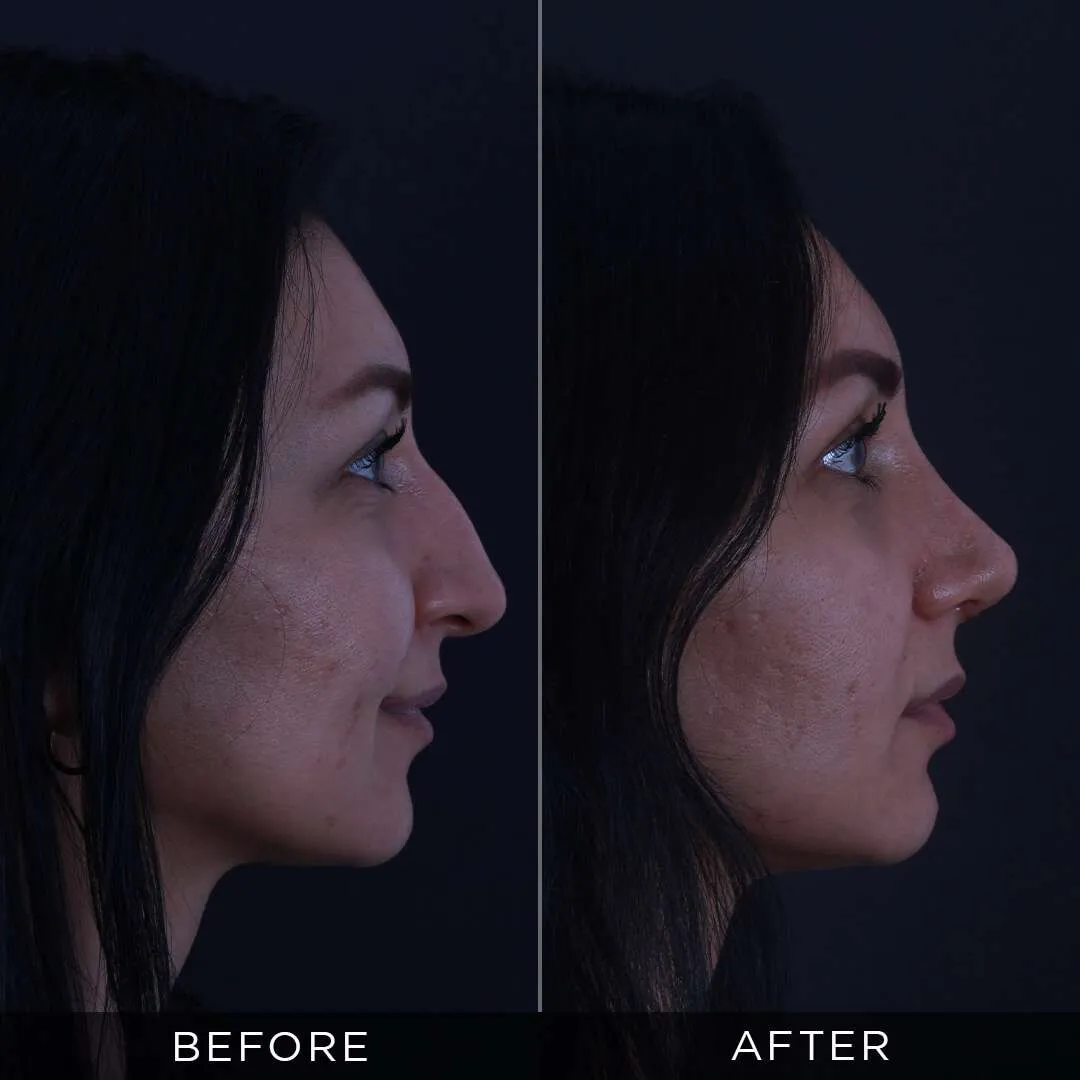 29 year old woman in istanbul before and after rhinoplasty
