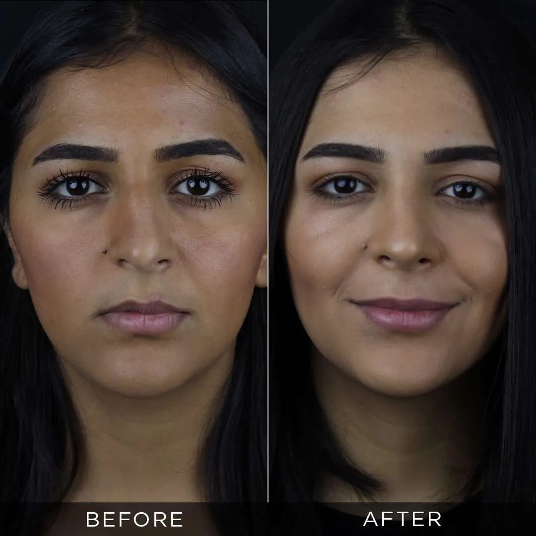 Septoplasty in Turkey 26 year old female piezzo rhinoplasty