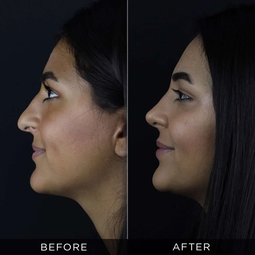 Septoplasty in Turkey 26 year old woman before and after rhinoplasty