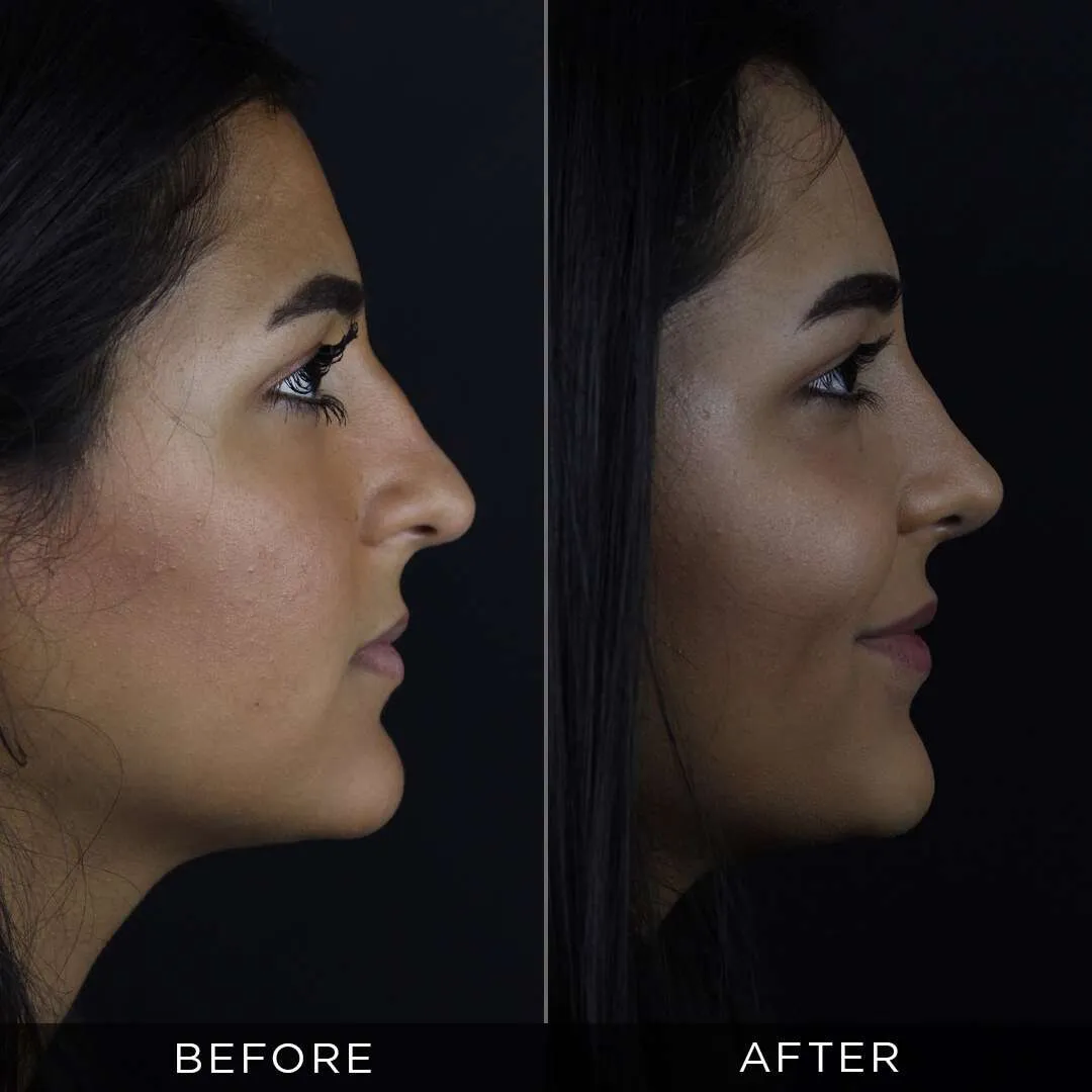 Septoplasty in Turkey rhinoplasty for women 26 years old in turkey