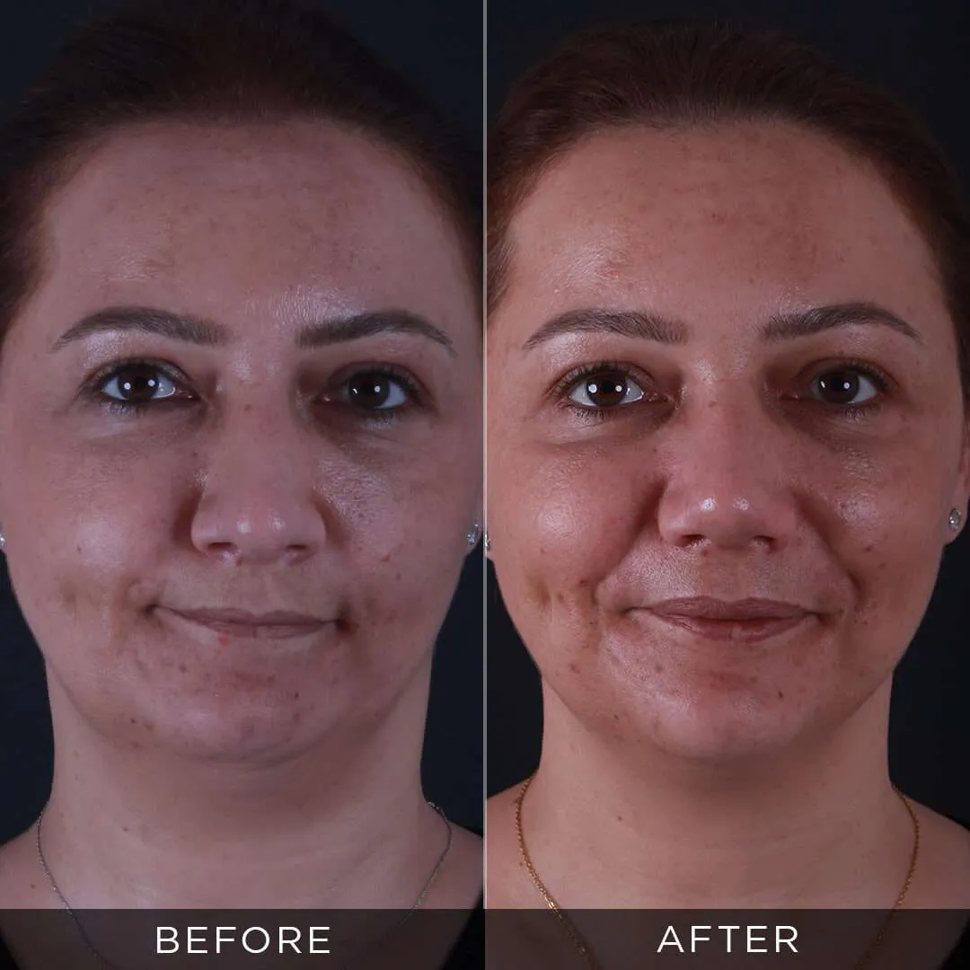 6 months after rhinoplasty at 36 years old