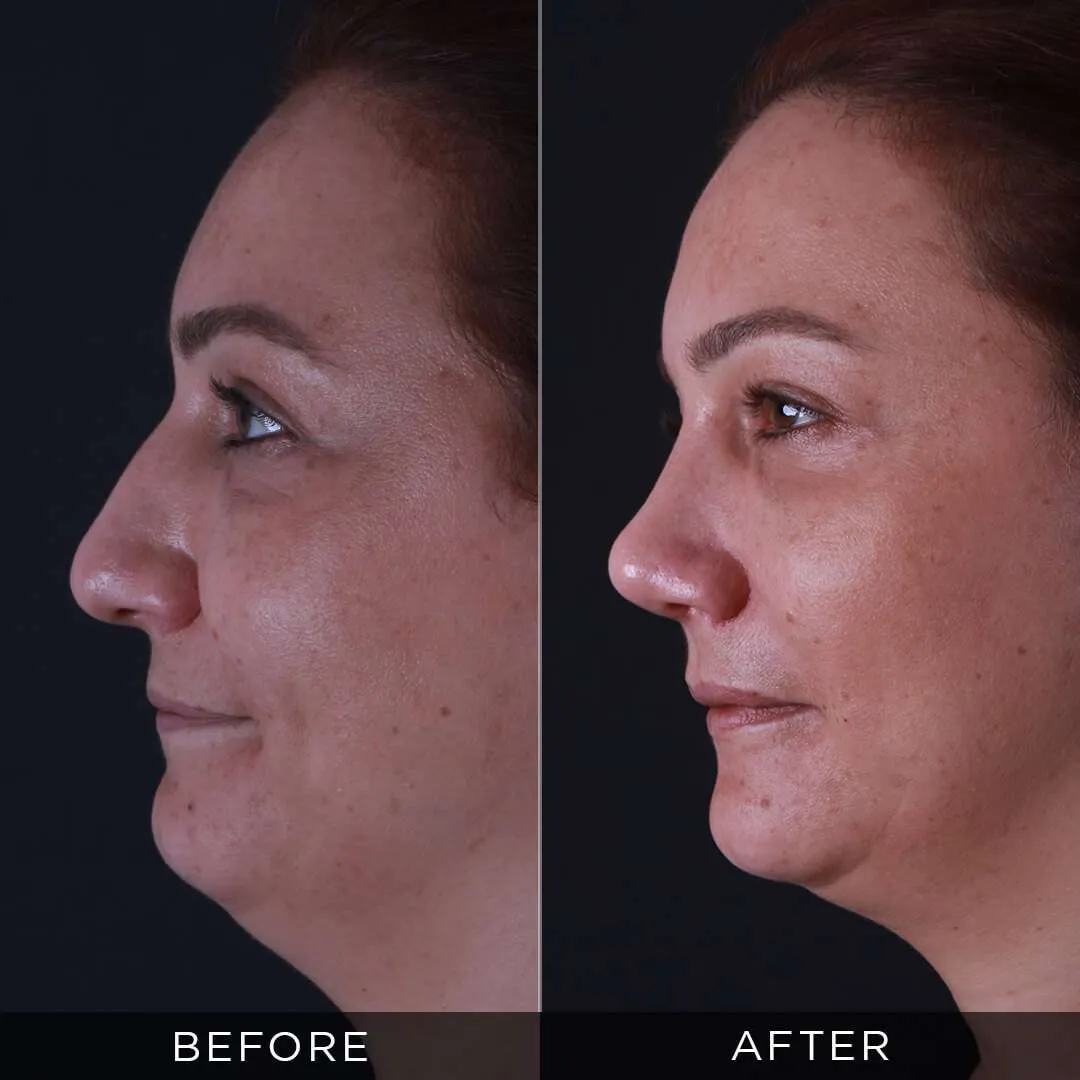 36 years old before and after rhinoplasty