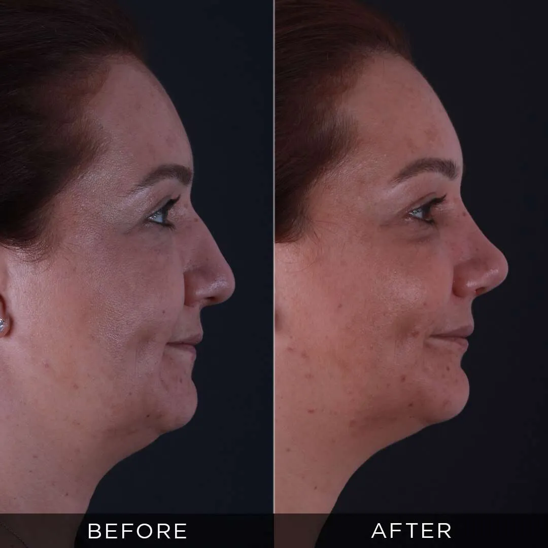 36 year old woman before and after rhinoplasty