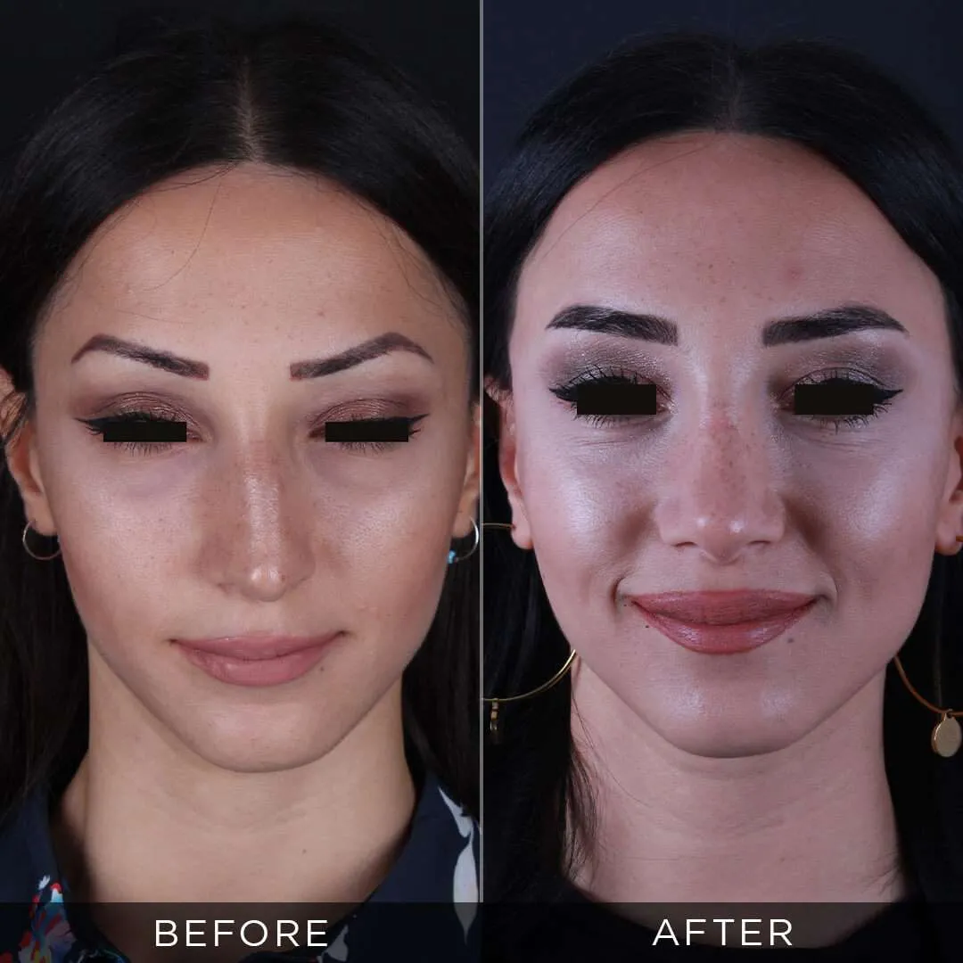 Rhinoplasty Before & After Gallery