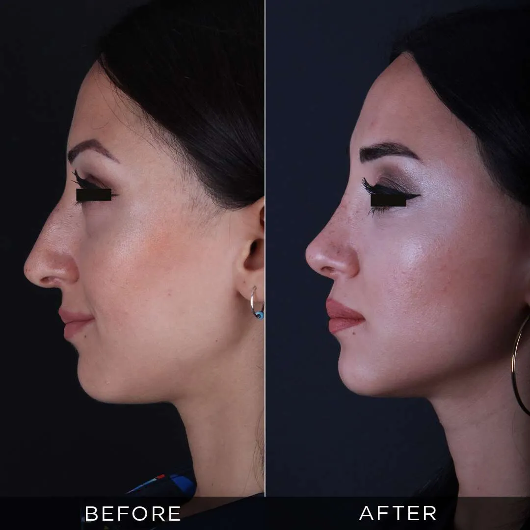 Rhinoplasty Before & After Gallery