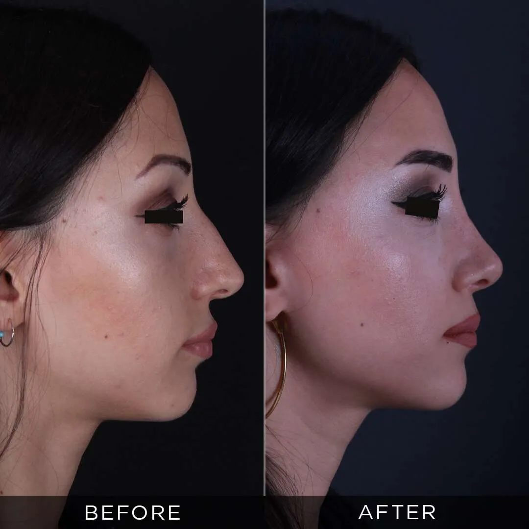Rhinoplasty Before & After Gallery