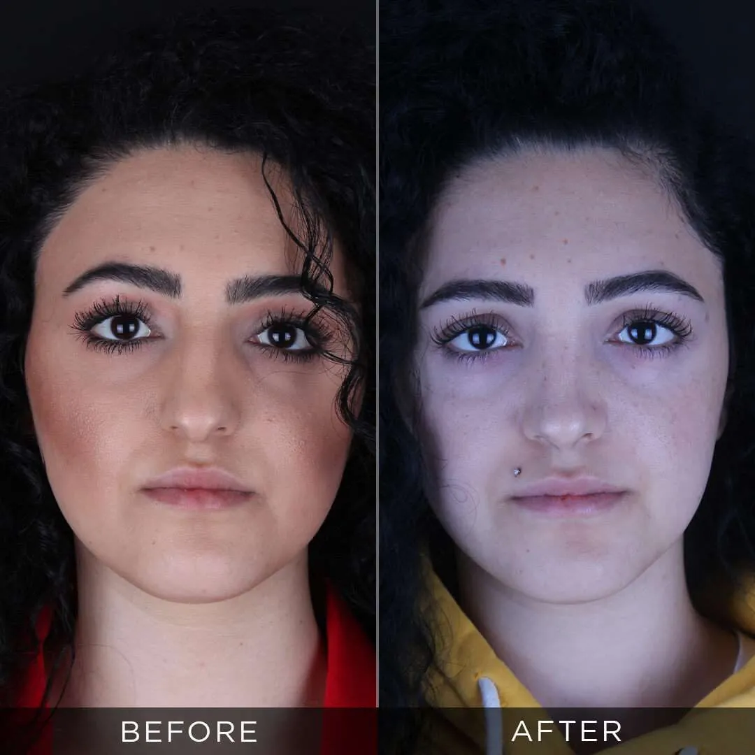 one year after rhinoplasty for women