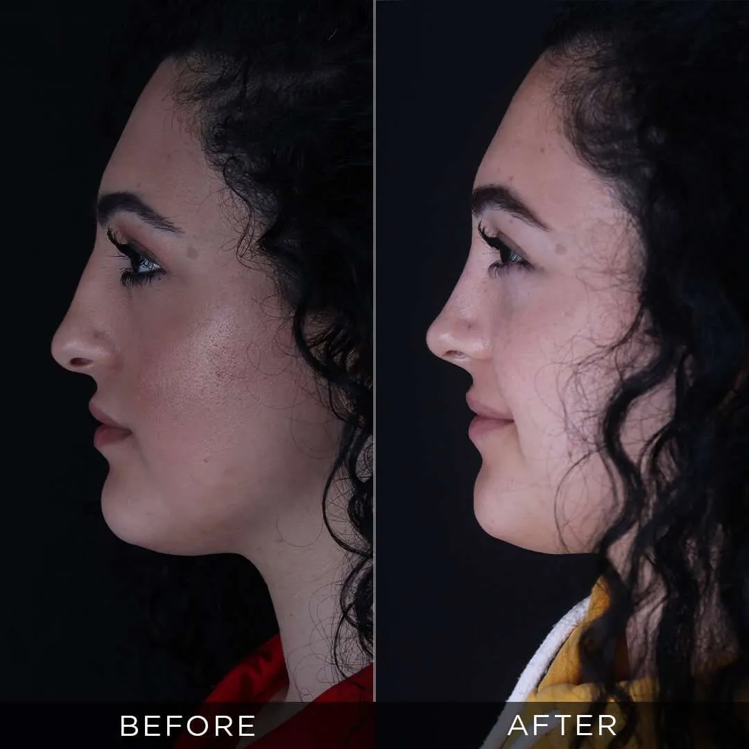 one year after female rhinoplasty