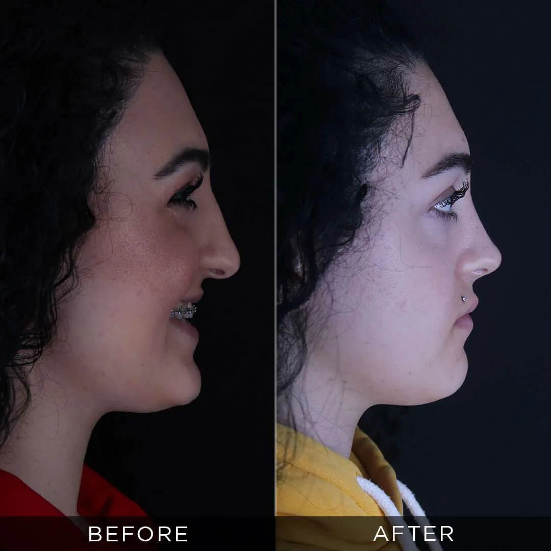 rhinoplasty at the age of 25 in turkey