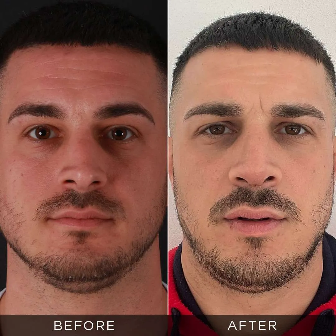 Rhinoplasty Before & After Gallery