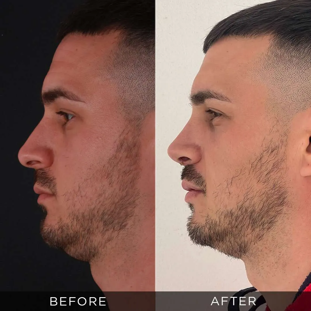 Rhinoplasty Before & After Gallery