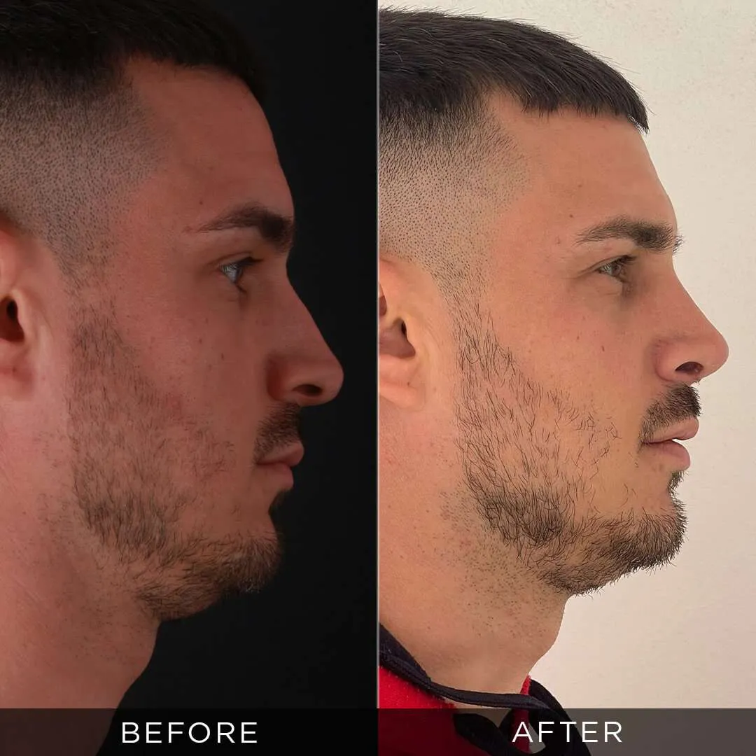 Rhinoplasty Before & After Gallery