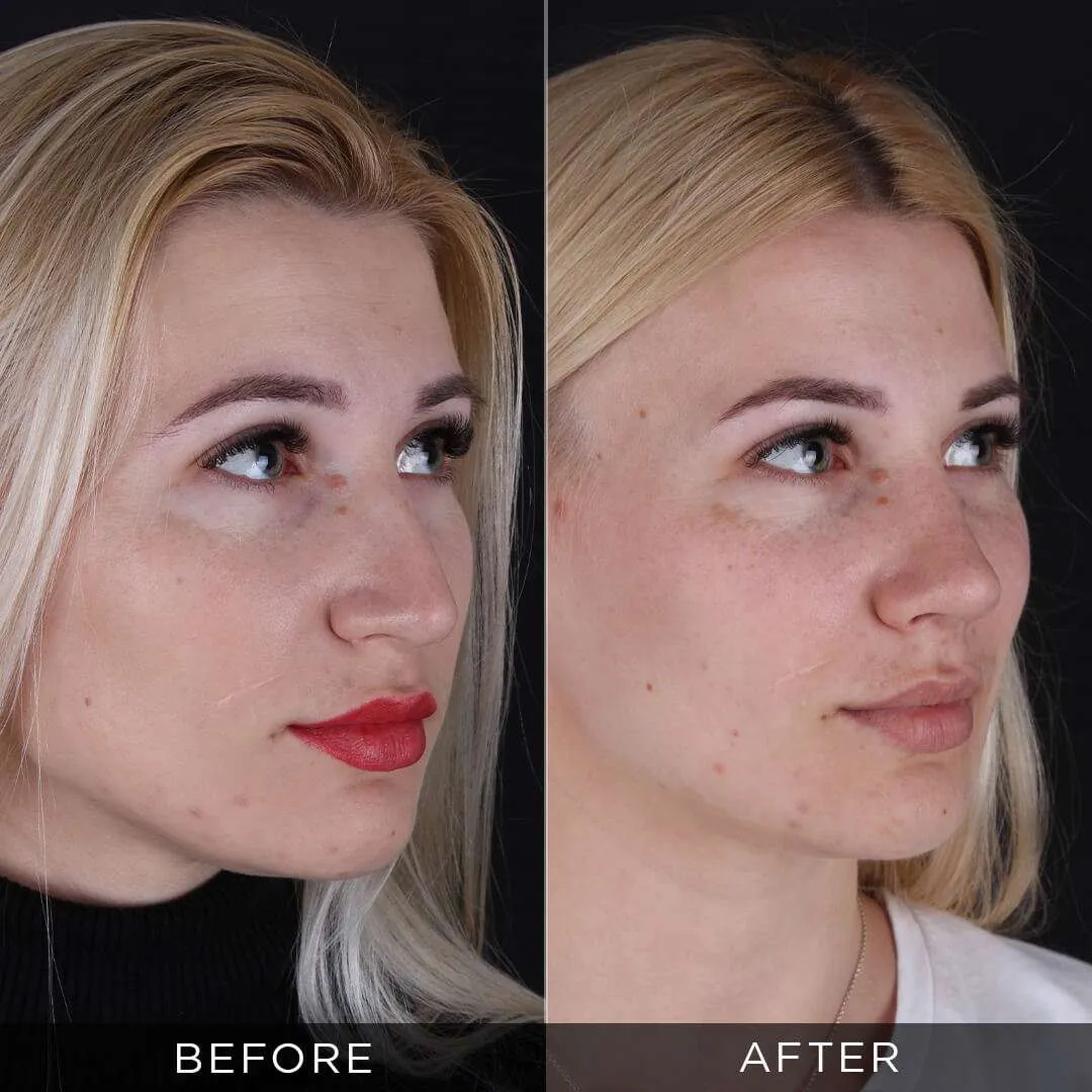 8 months after rhinoplasty