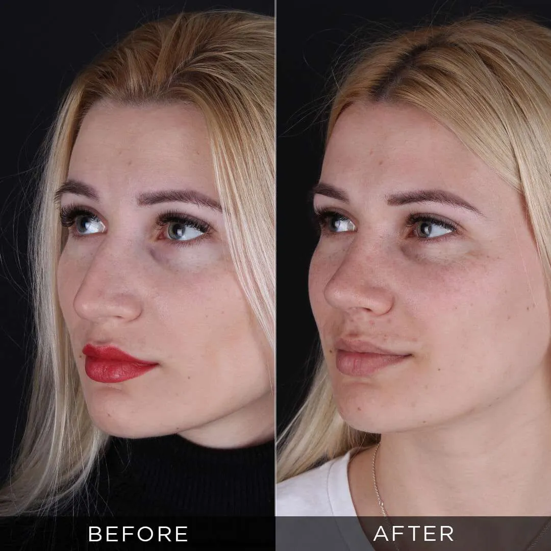 female-rhinoplasty