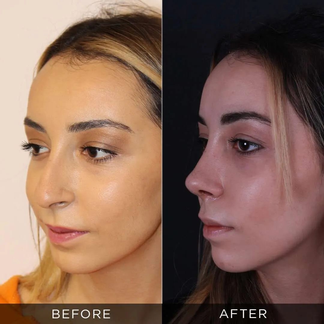 rhinoplasty 3 months post op