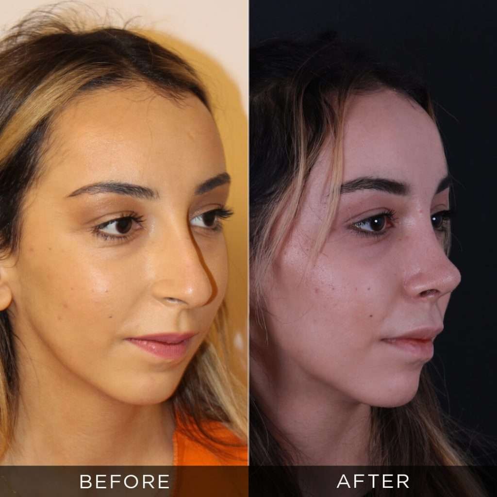 Rhinoplasty Before & After Gallery - Opr. Dr. Hasan Duygulu
