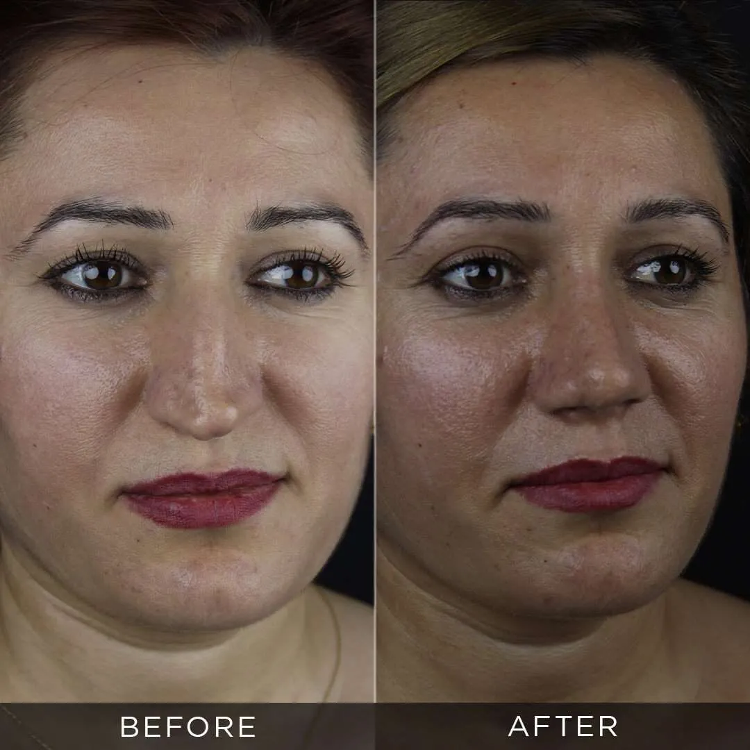 35 year old woman rhinoplasty