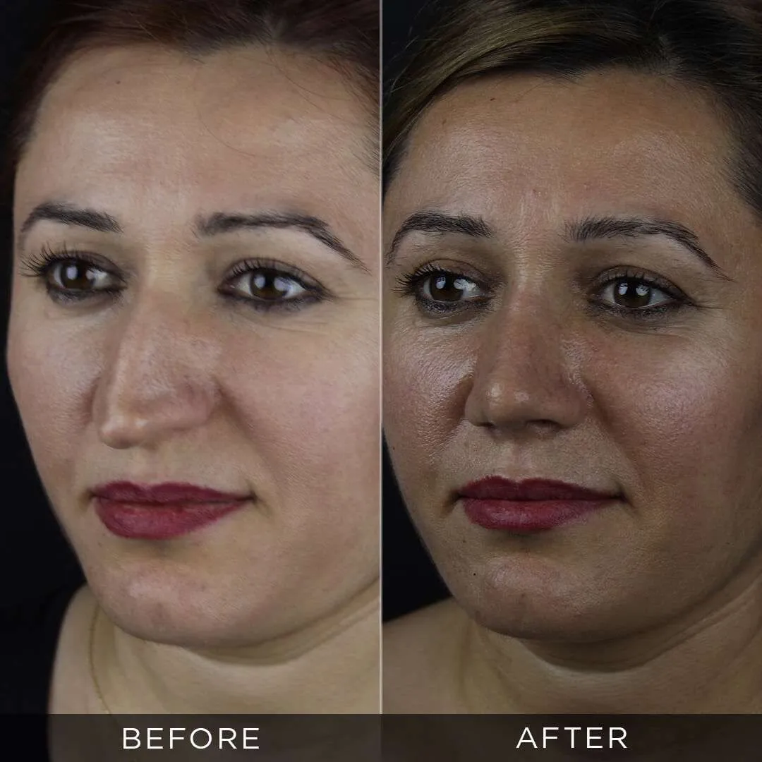 35 year old woman before and after rhinoplasty