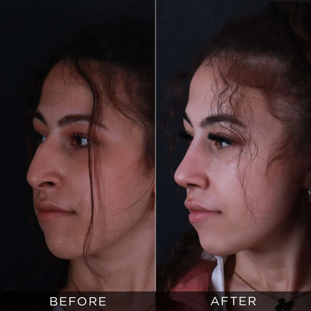 22 year old female rhinoplasty