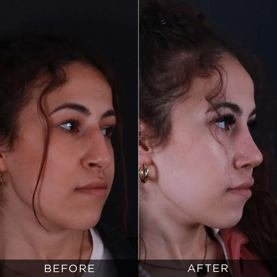 22 year old female rhinoplasty in Turkey