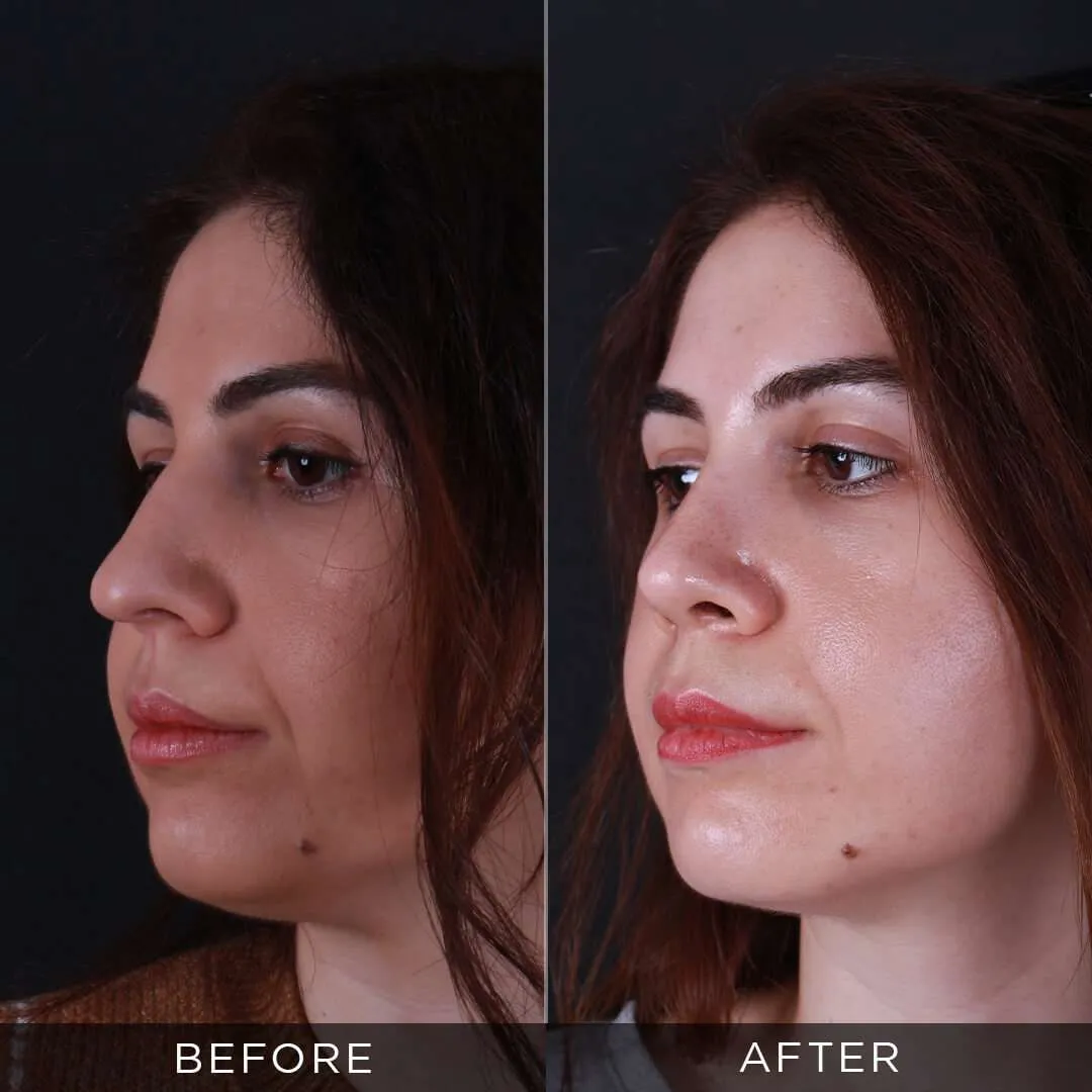 34 year old female rhinoplasty