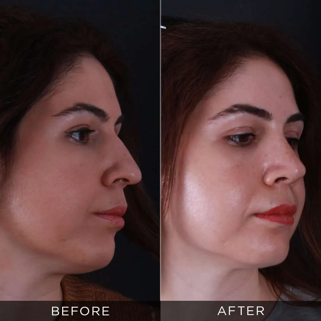 woman before and 3 months after rhinoplasty