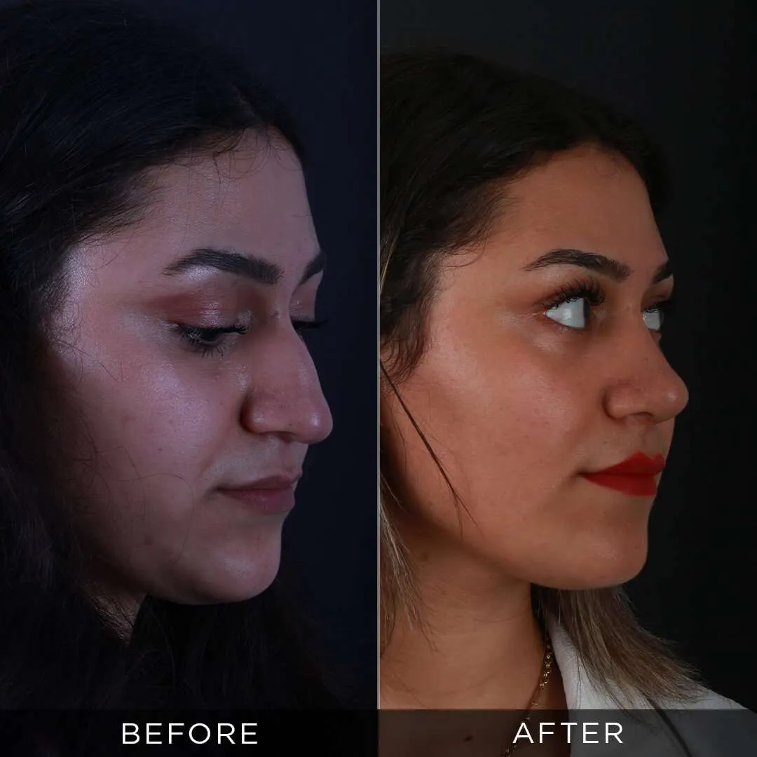 26 year old female rhinoplasty