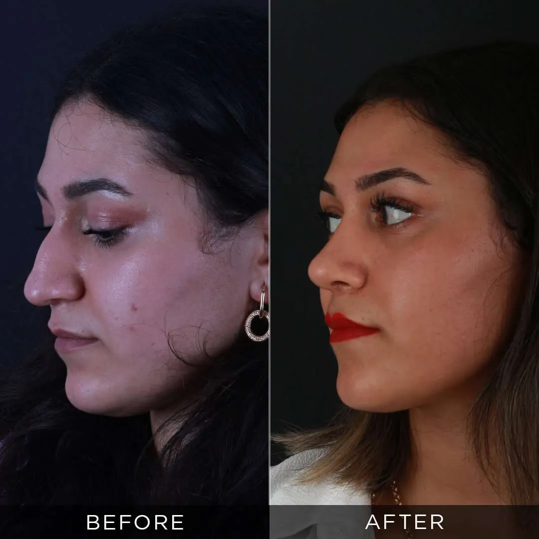 26 years old rhinoplasty post op 8 months