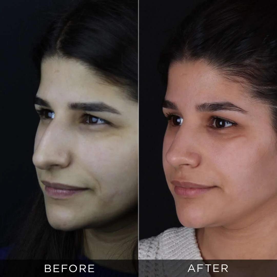26 years old before and after rhinoplasty