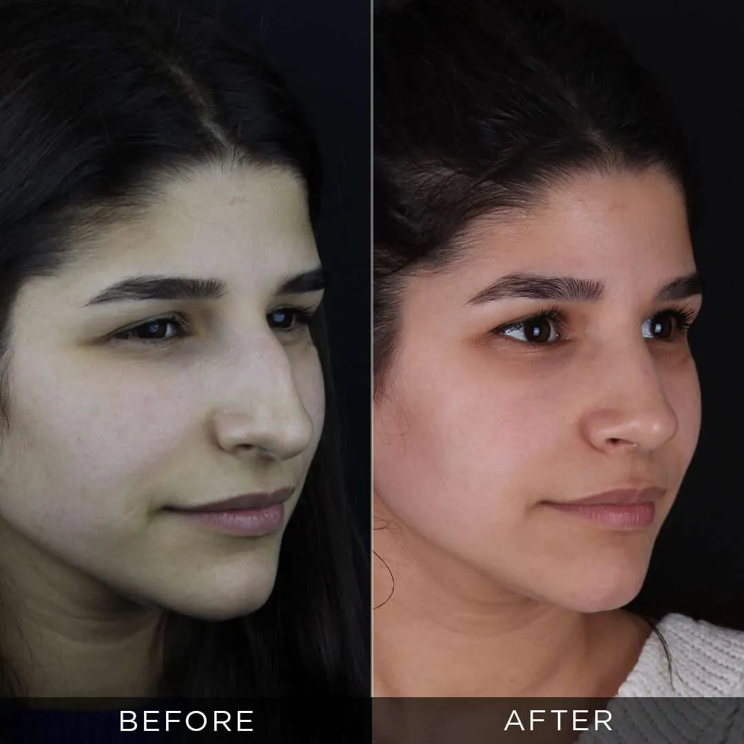 female rhinoplasty 6 months after