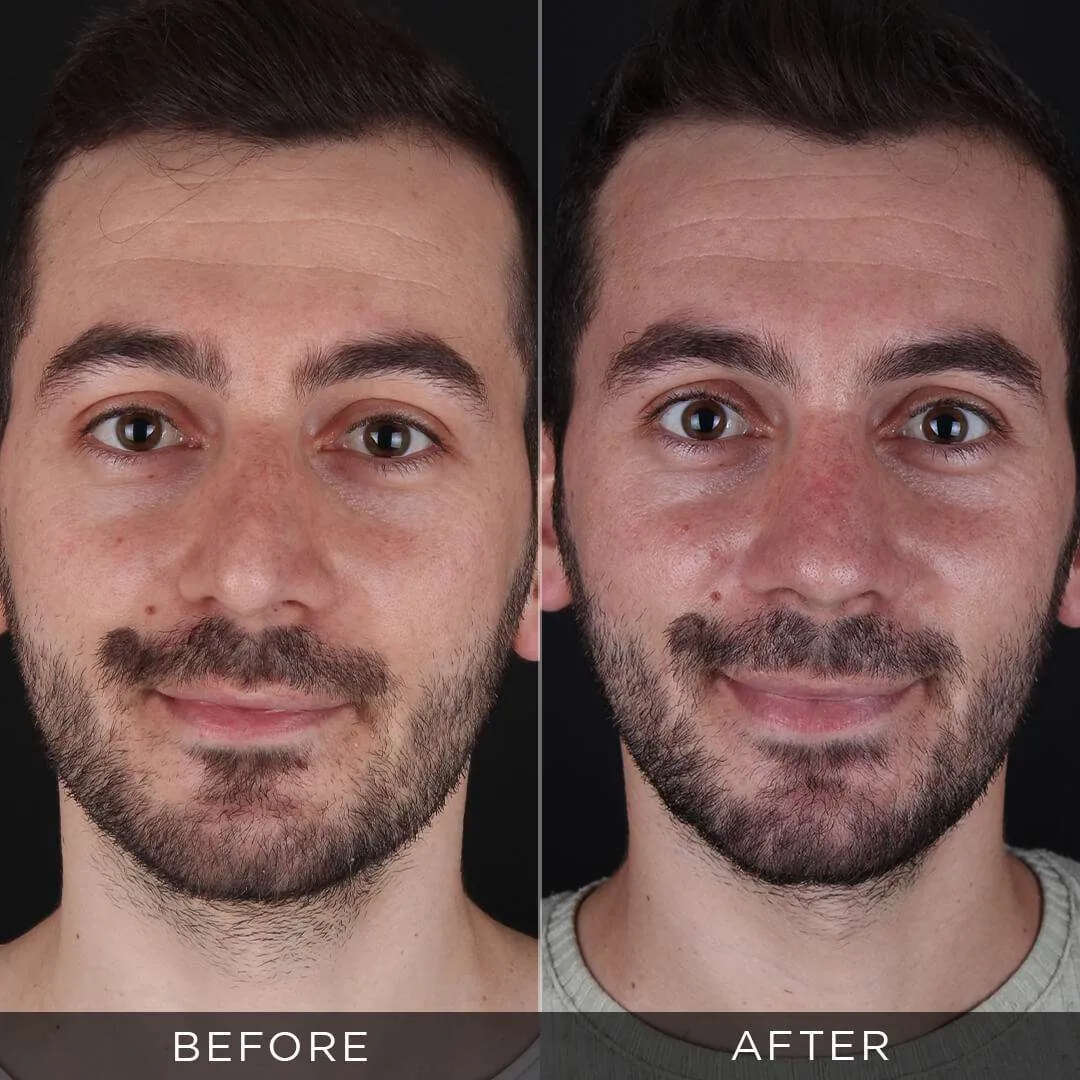 male rhinoplasty two weeks after