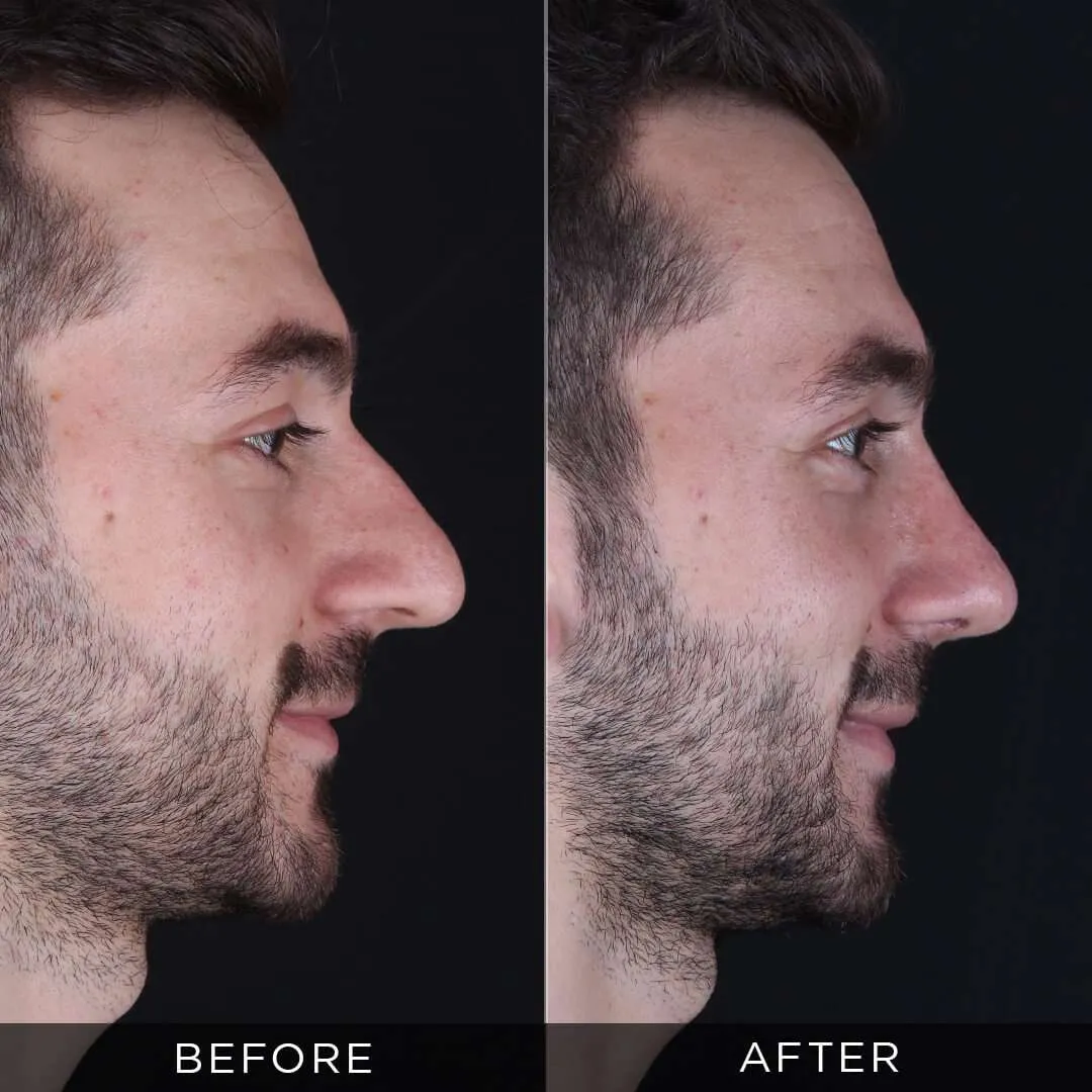 28 year old male rhinoplasty