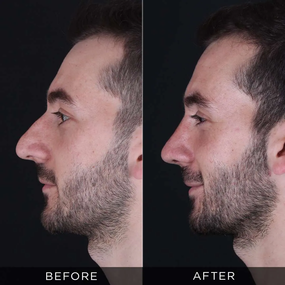 28 year old male rhinoplasty in istanbul