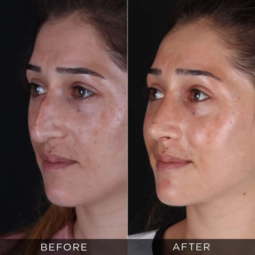 33 years old before and after rhinoplasty