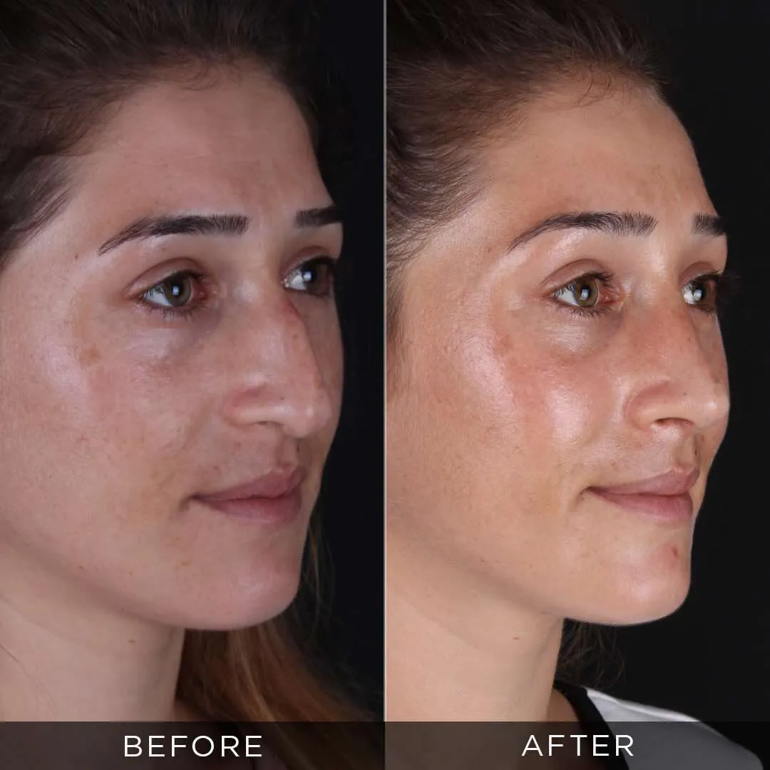 33 year old female rhinoplasty