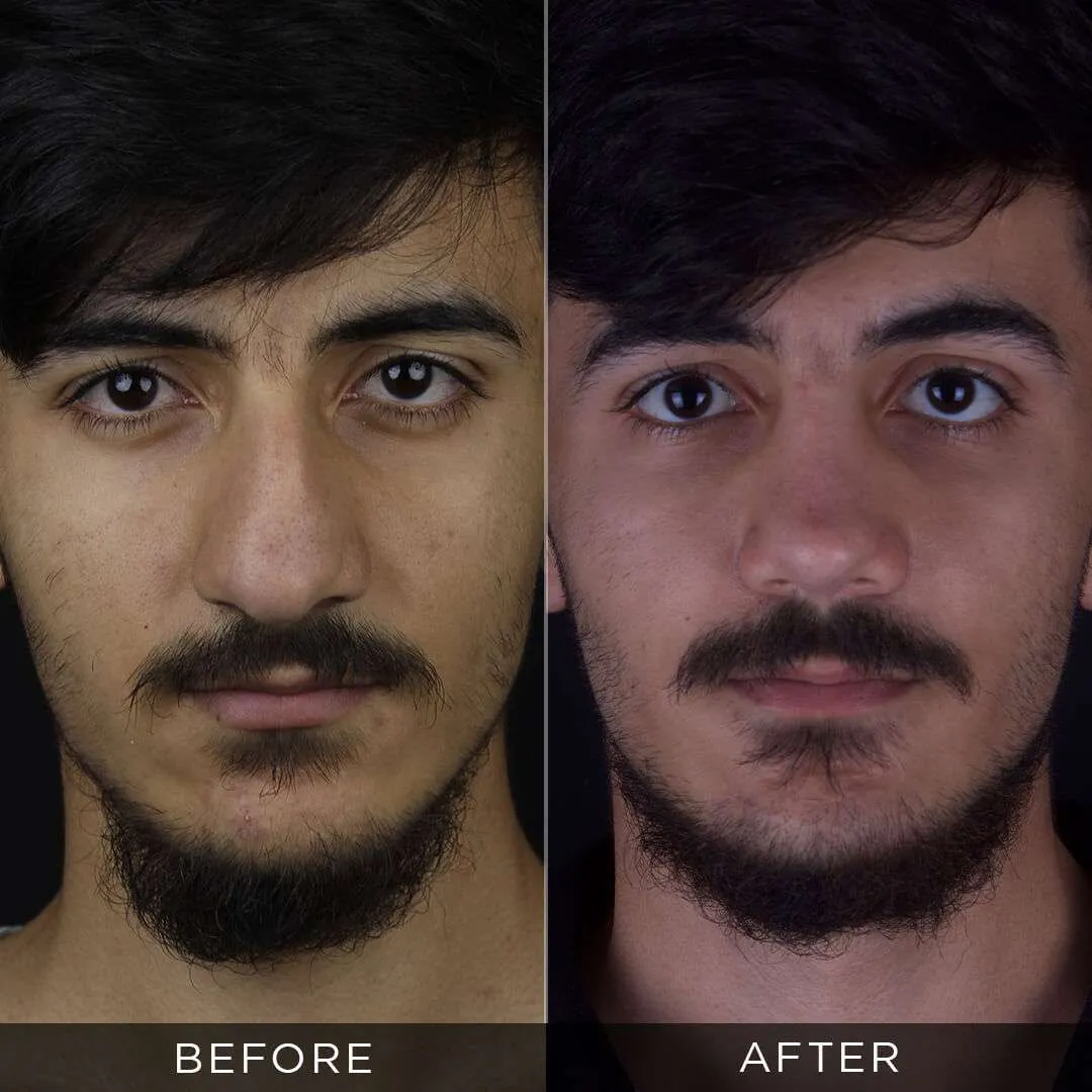 Rhinoplasty Before & After Gallery