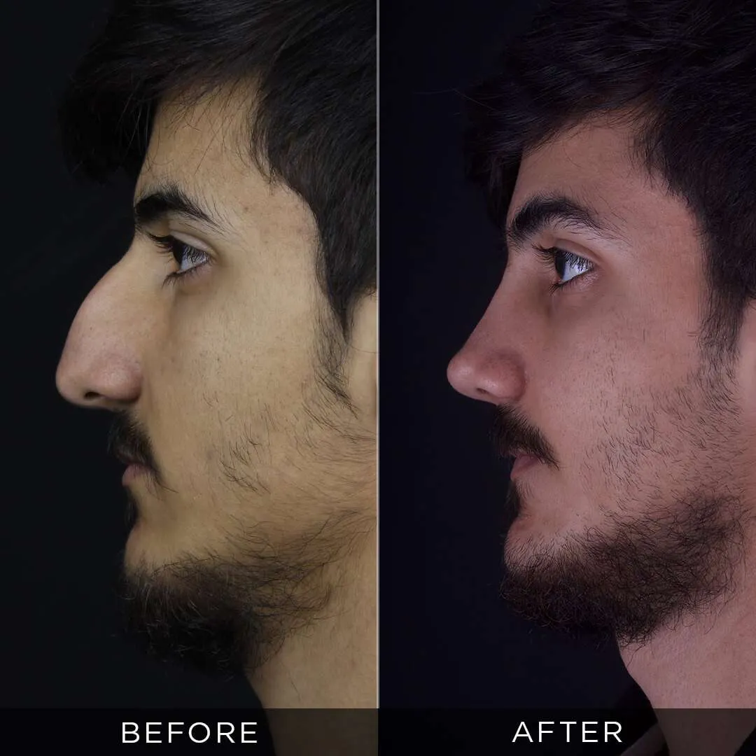 Rhinoplasty Before & After Gallery
