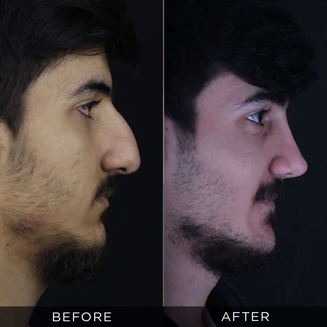 Rhinoplasty Before & After Gallery