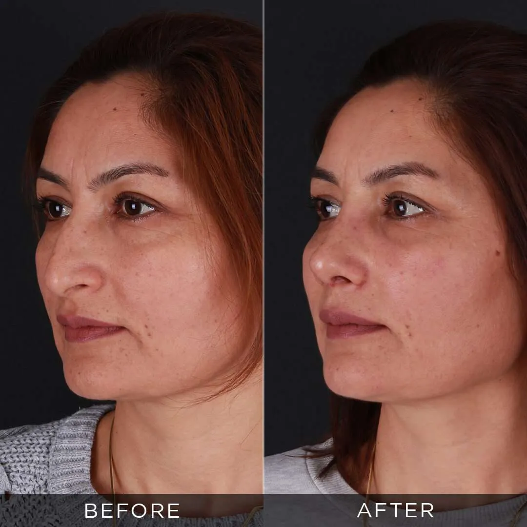 female 1 month after rhinoplasty