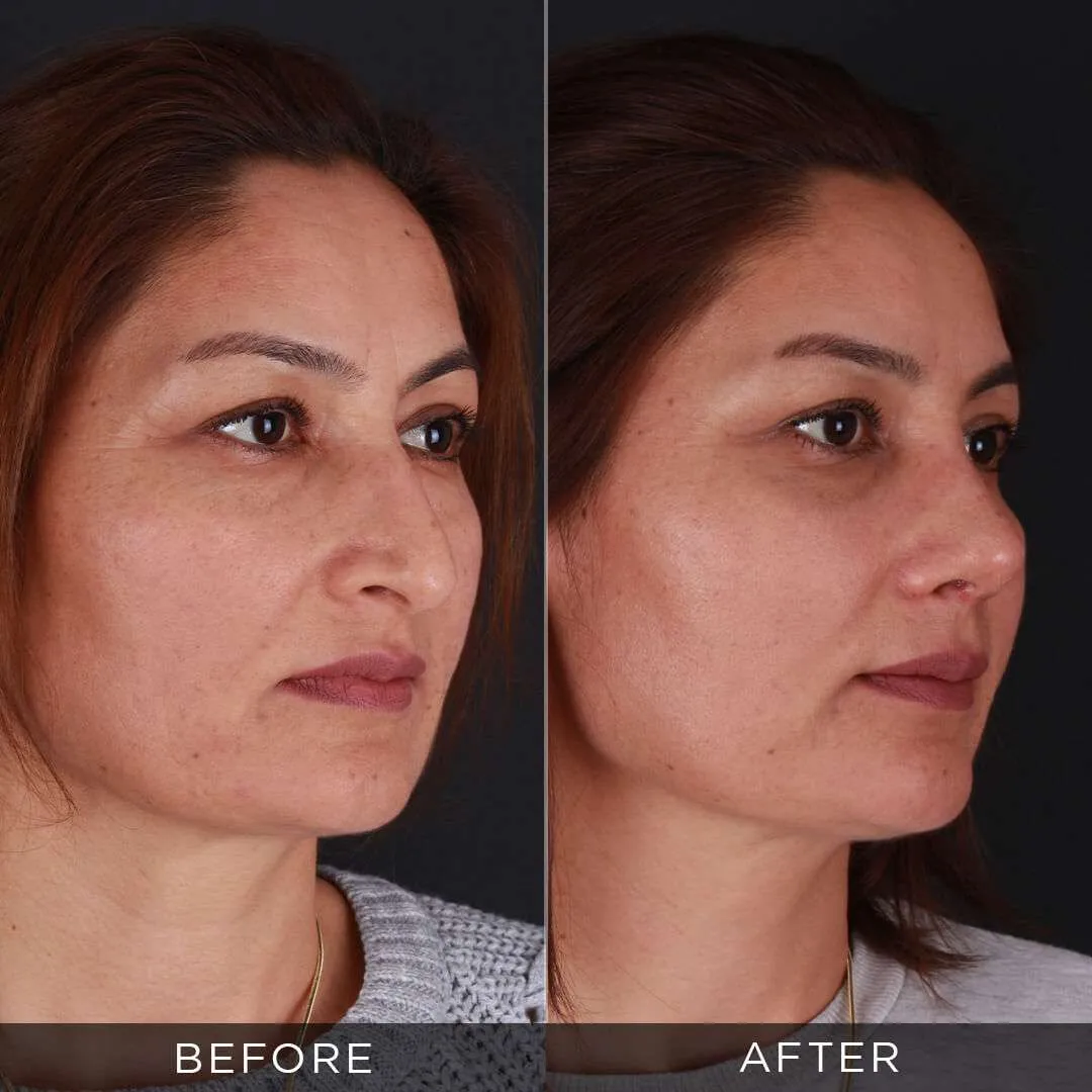 34 years old before and after rhinoplasty