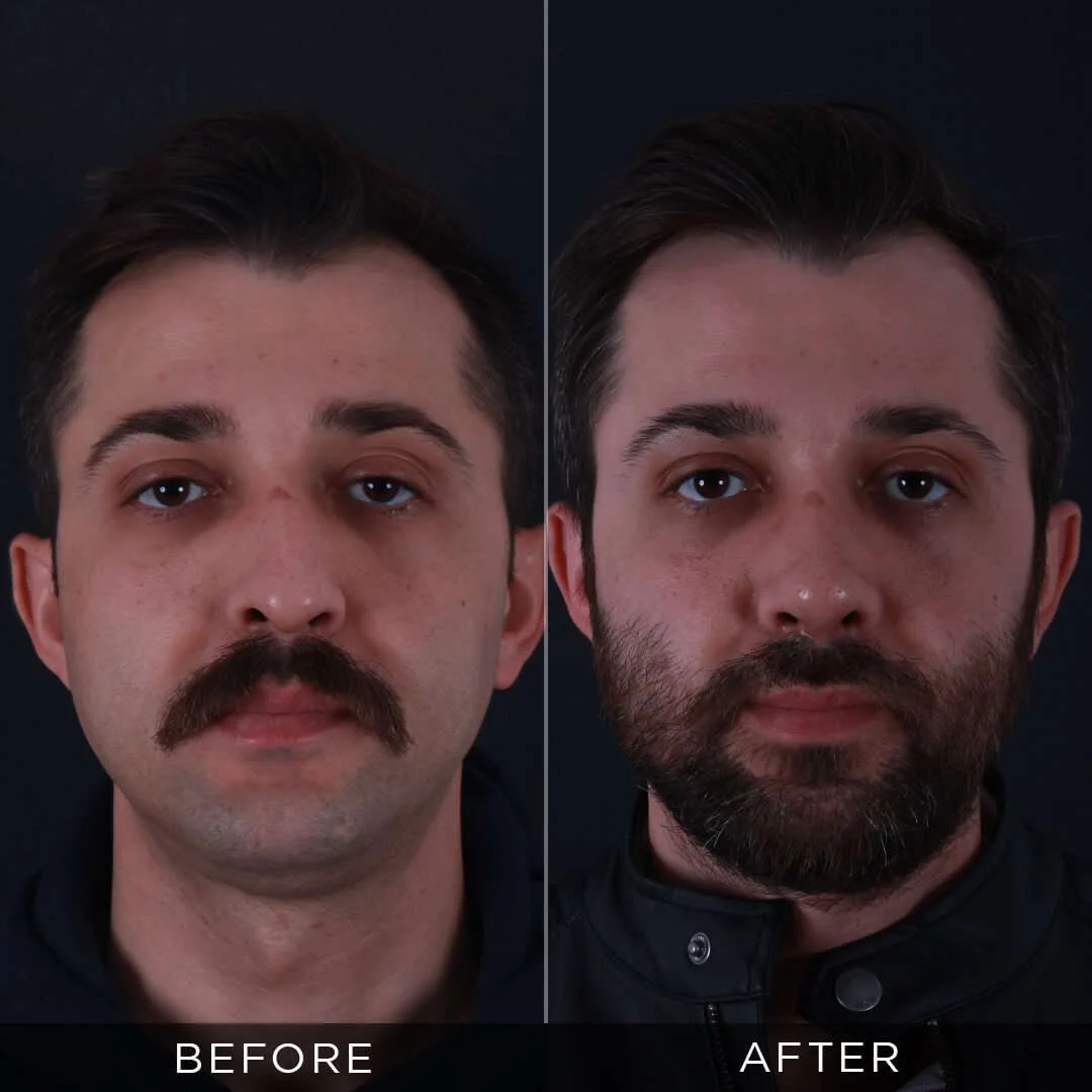 male rhinoplasty in istanbul