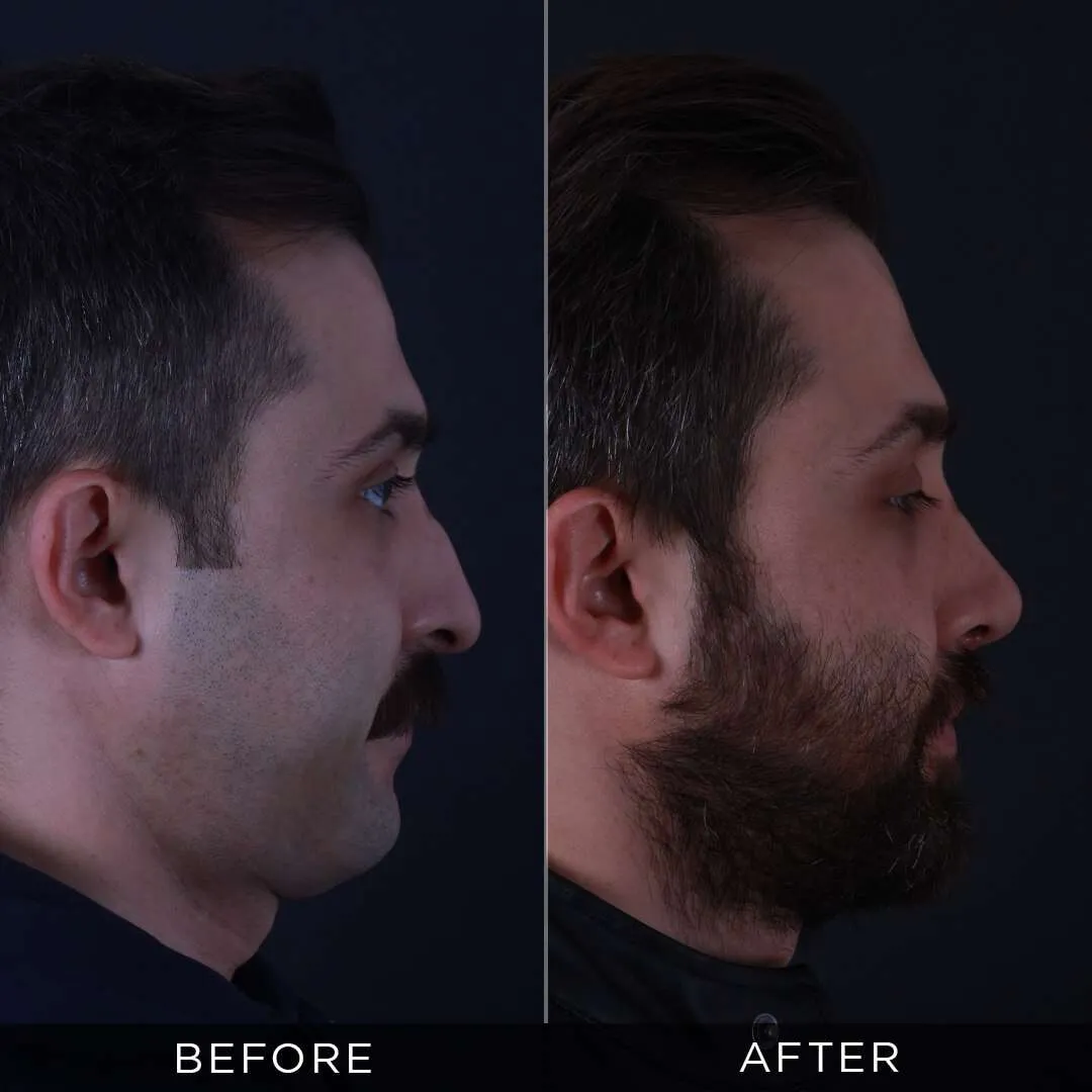 31 years before and after rhinoplasty