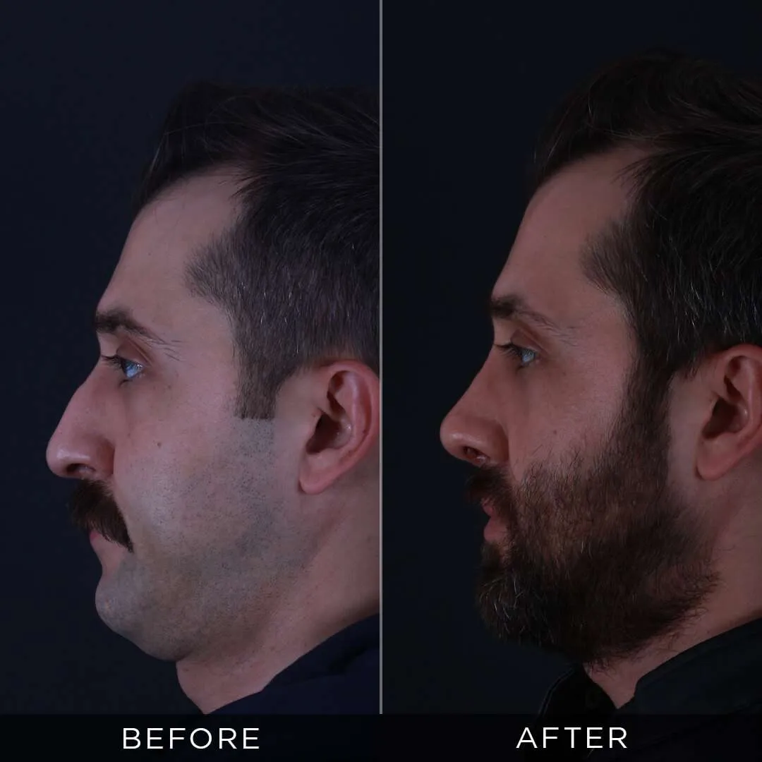 one year after rhinoplasty for men