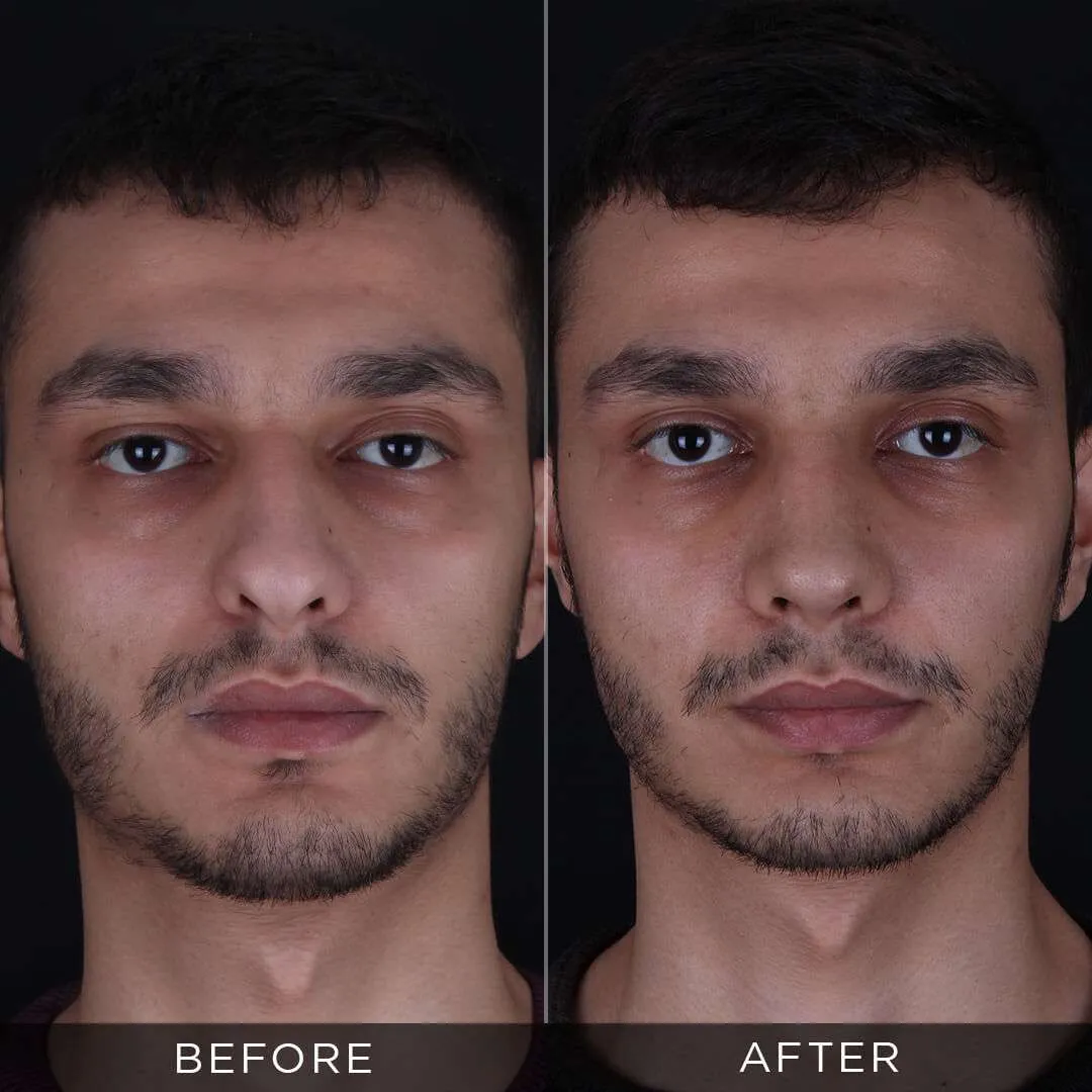 male rhinoplasty in istanbul 26 years old